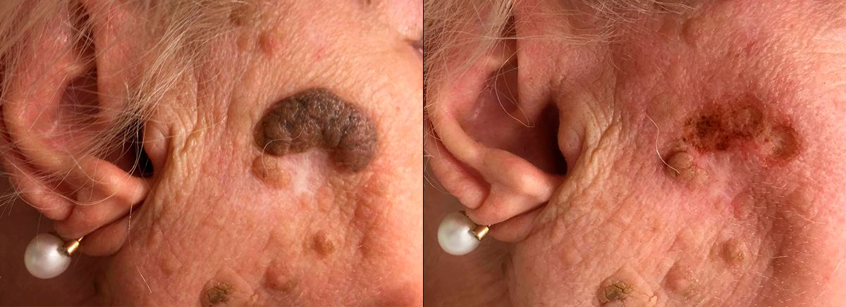 Удаление кератомы на лице