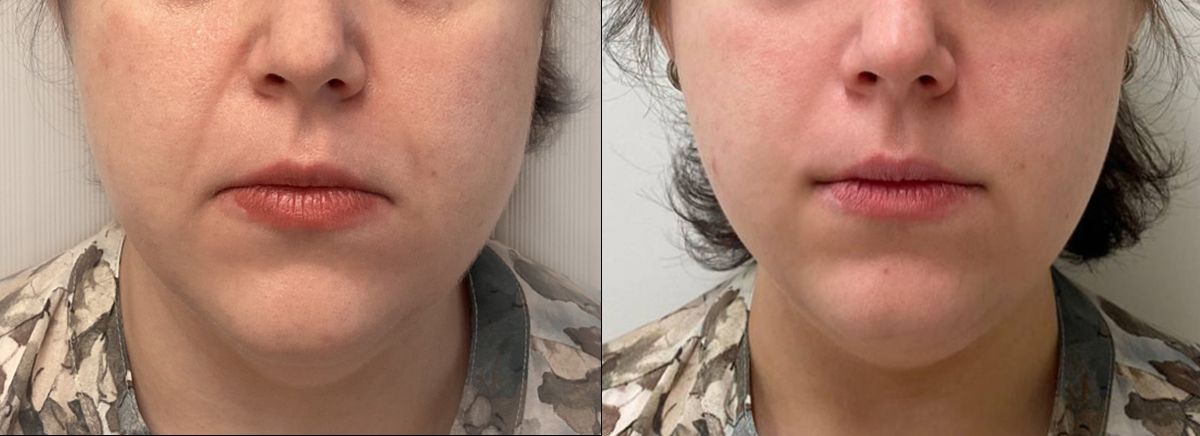 Scarlet микроигольчатый RF-лифтинг лицо