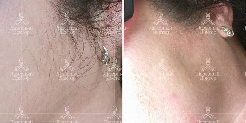 Удаление волос на лице лазером навсегда (фото)