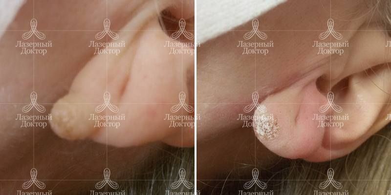 Лазерное удаление невуса на ухе