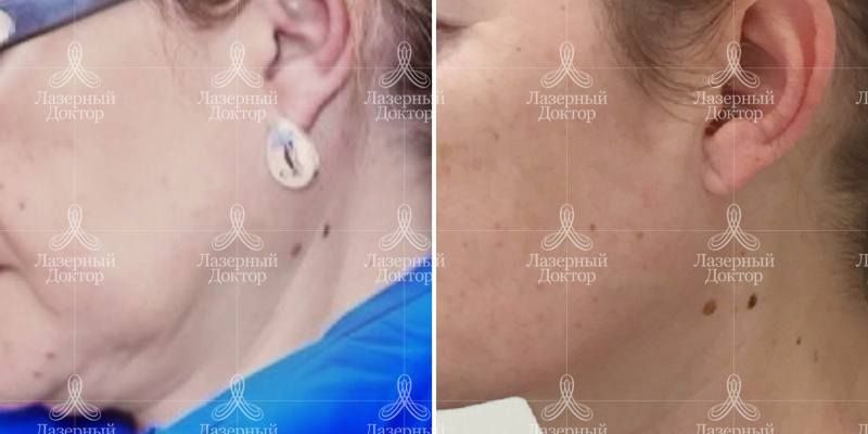 3d лифтинг на аппарате infini