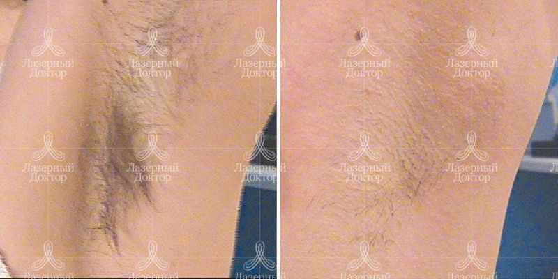 Лазерная эпиляция Мовео в зоне подмышечных впадин