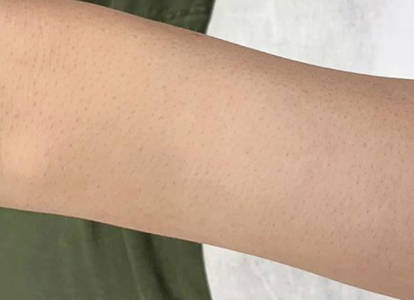 Лазерная эпиляция фото до и после