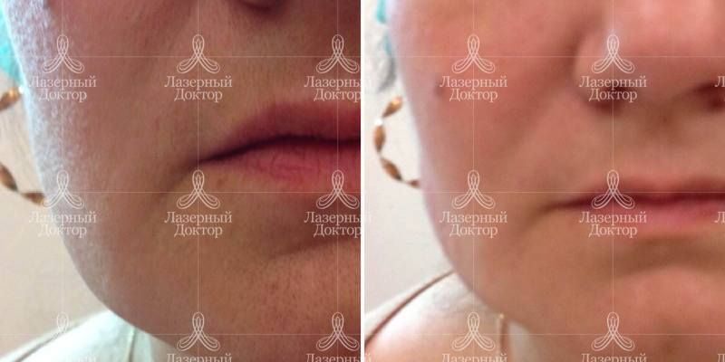 Мезонити (фото до и после)