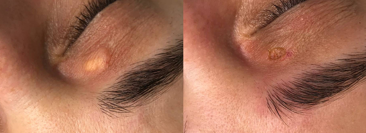 удаление новообразования