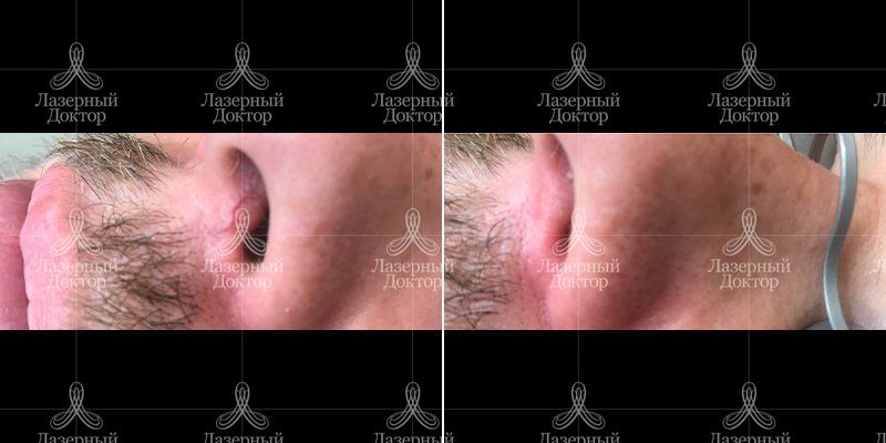 Удаление сосудов