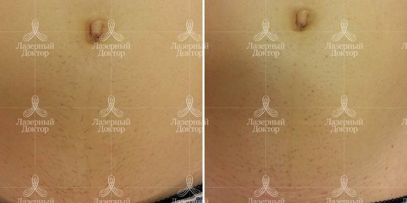 Удаление нежелательных волос на животе (фото до и после)