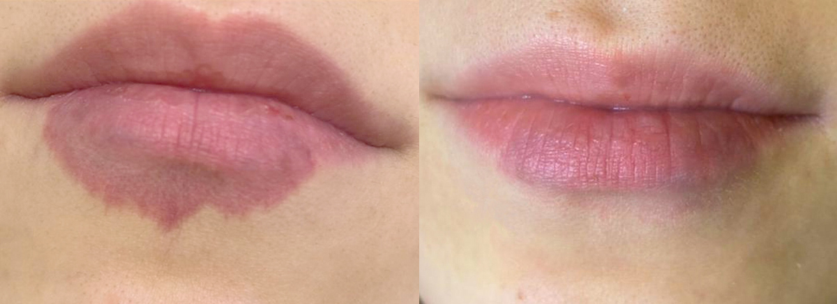 Удаление сосудов - гемангиома