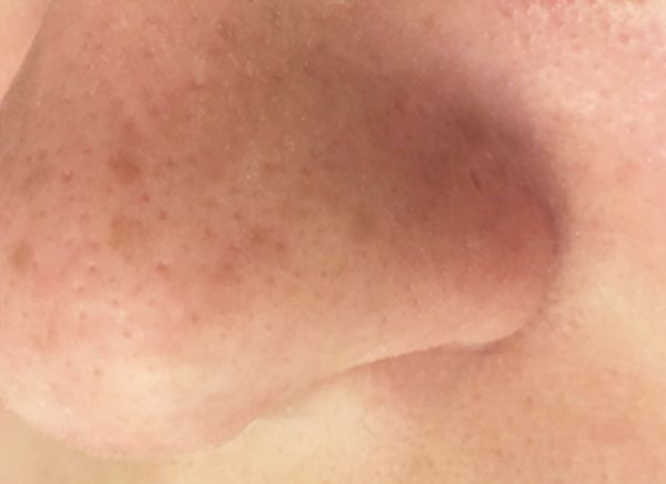 Ультразвуковая чистка лица фото до и после