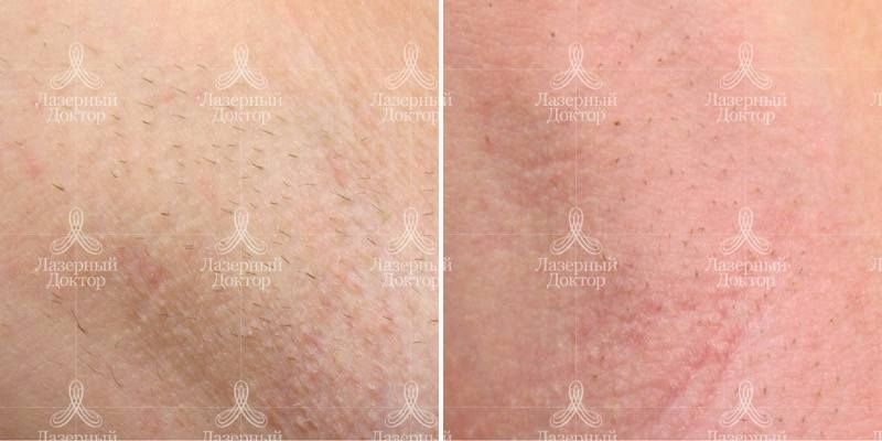 Результат процедуры удаления нежелательной растительности