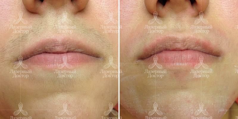 Лазерная эпиляция волос на лице (результат на фото)