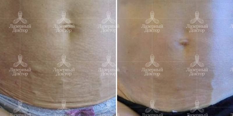 Фото до и после пилинга тела