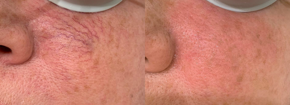 удаление сосудов - щека