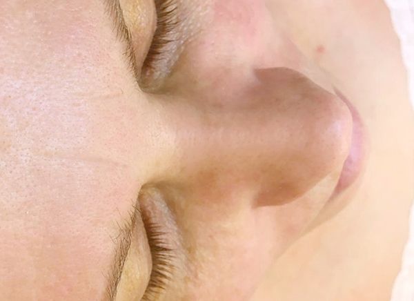 Ультразвуковая чистка лица фото до и после