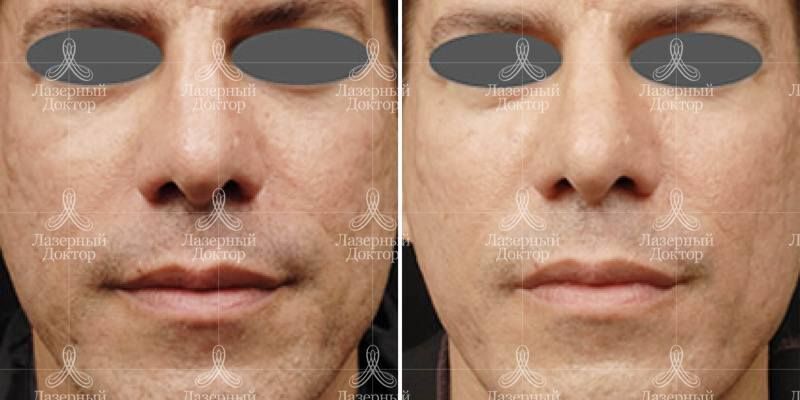 3d волюмизация от шрамов