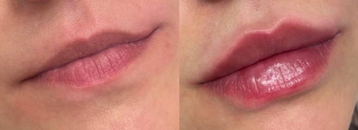 Контурная пластика губ 
