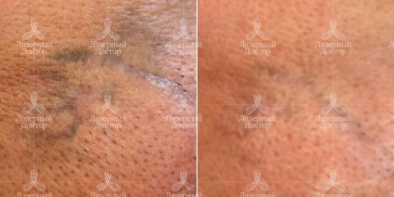 удаление тату