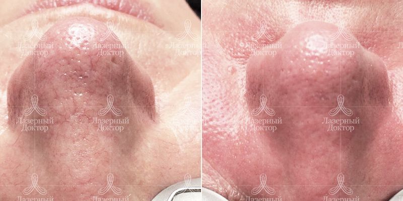 IPL фотолечение Quantum