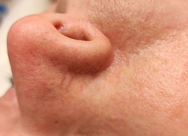 Удаление сосудов фото до