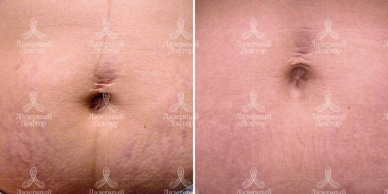 Лазерная коррекция растяжек (фото до и после)