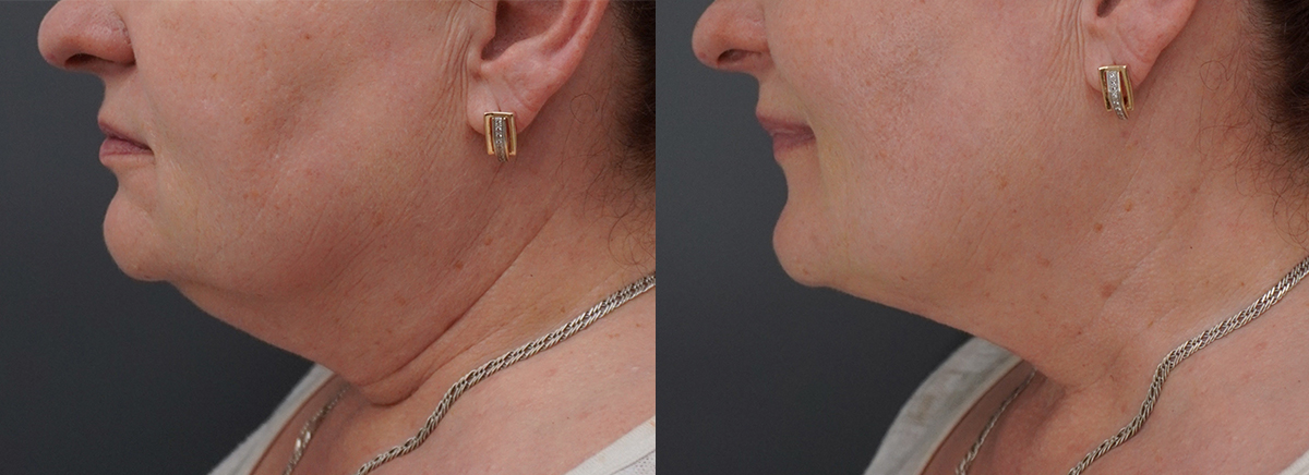 Ультраформер