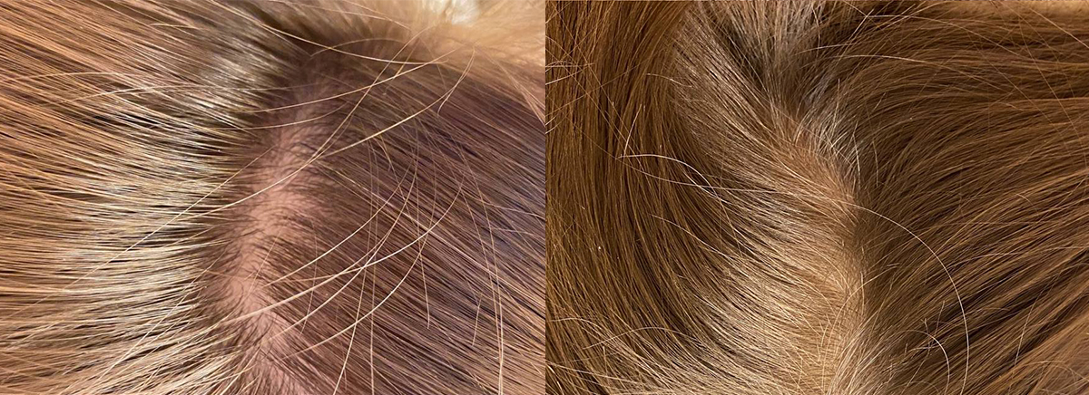 Мезотерапия волос