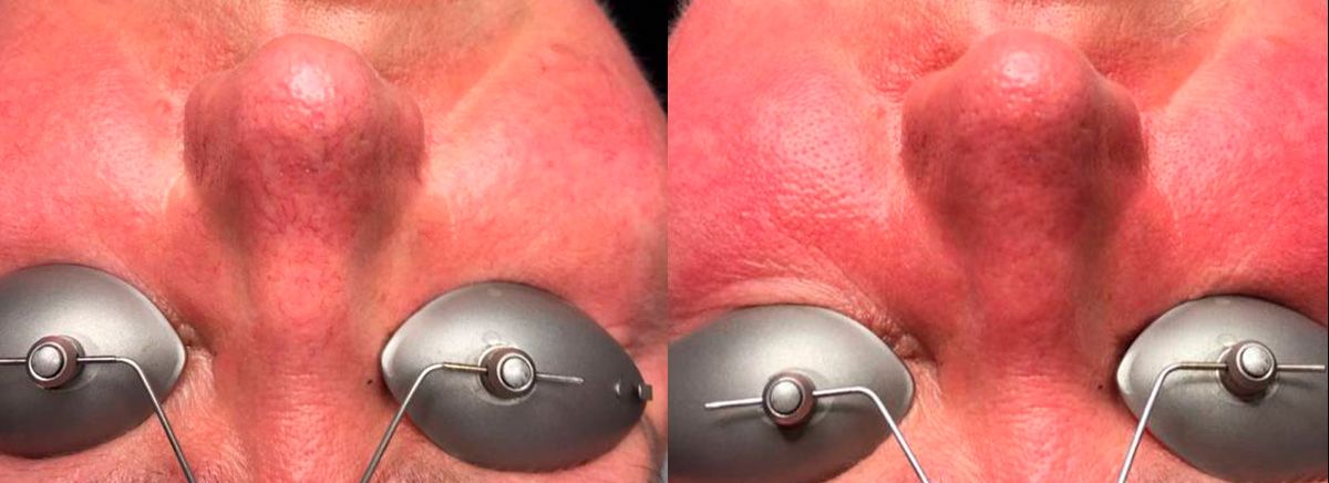 Удаление сосудов 