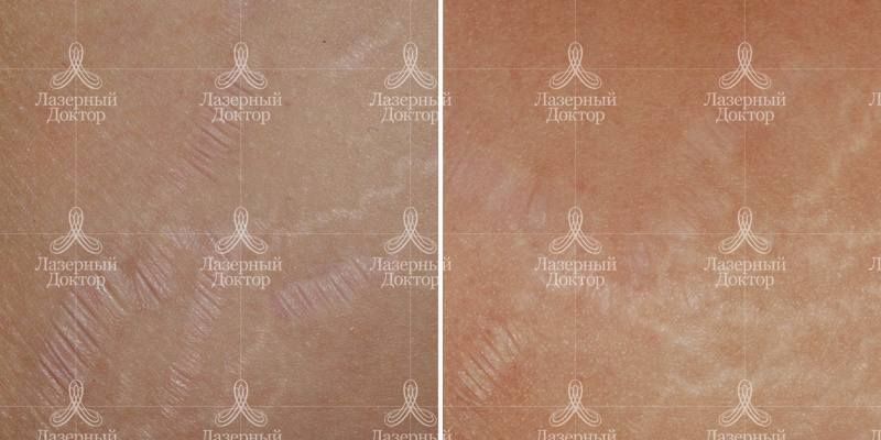Убрать растяжки лазером (фото до и после)