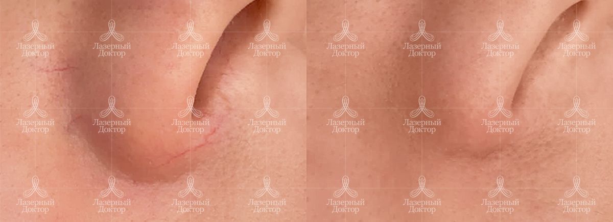 Удаление сосудов фото до и после