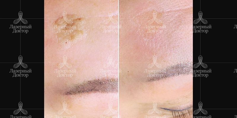 удаление новообразований