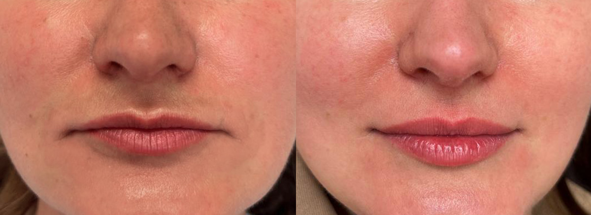 Контурная пластика губ 