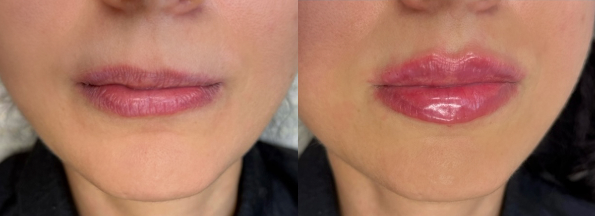 Контурная пластика губ Juvederm 