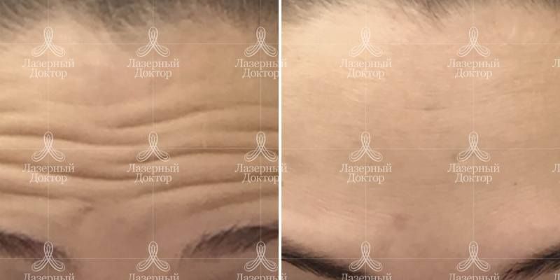 Ботокс в лоб: до и после фото