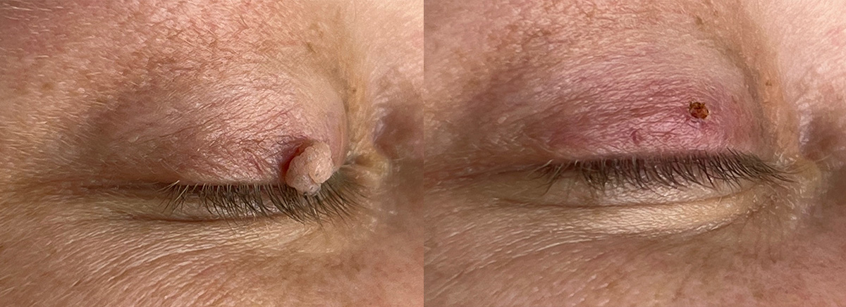 удаление папилломы 