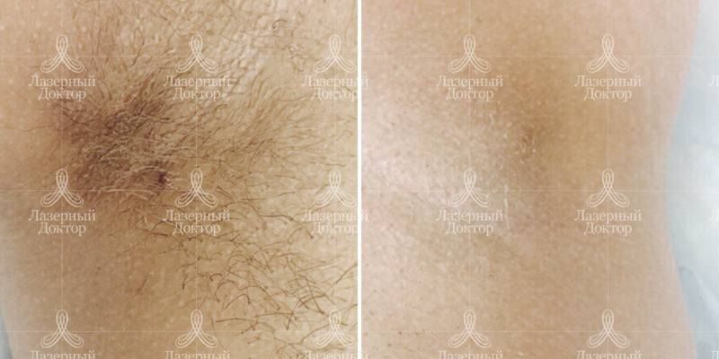 Подмышки после эпиляции александритовым лазером (результат)