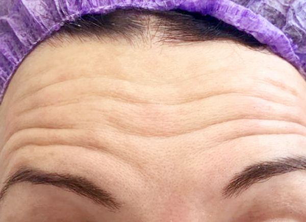 Инъекции ботокса фото до и после