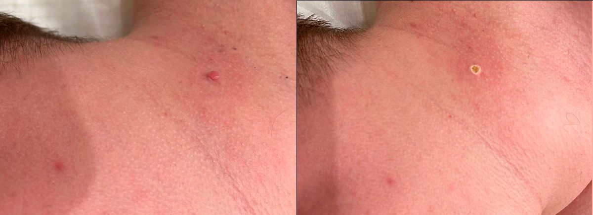 Удаление новообразования