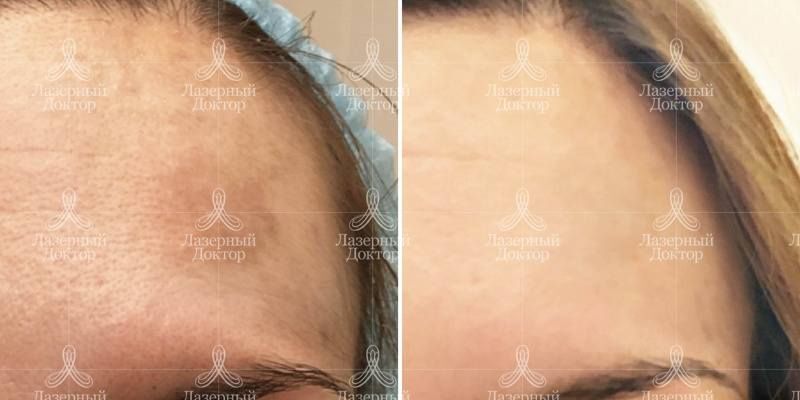 ДОТ омоложение - что это?