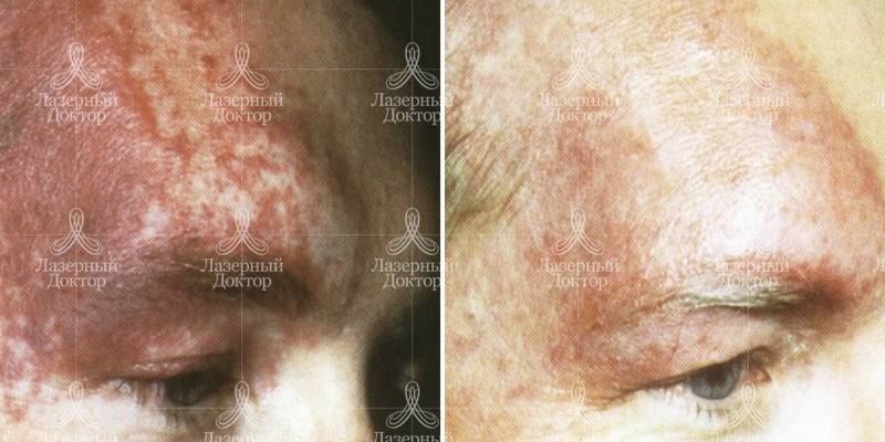 Фотоомоложение ipl quantum на лице
