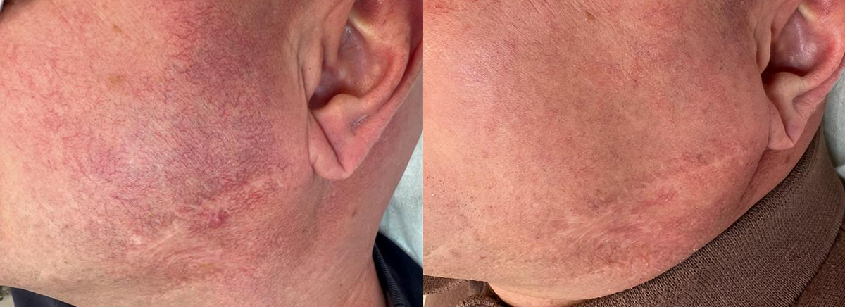 Удаление сосудов - розацеа