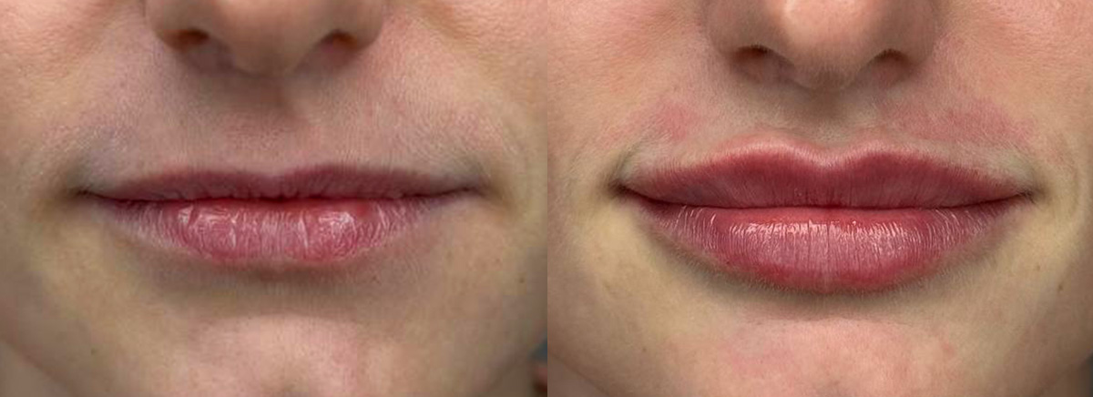 Контурная пластика губ 