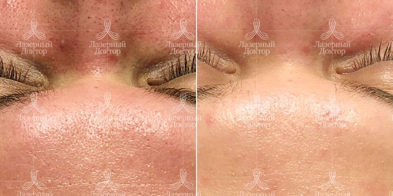 чистка до и после