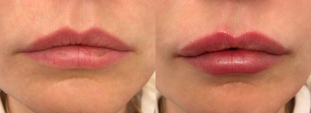 Контурная пластика губ ювидерм 3