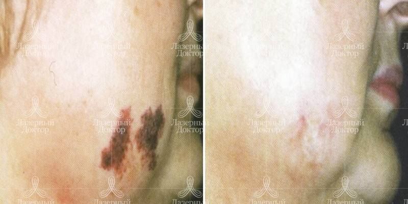 ipl quantum на лице