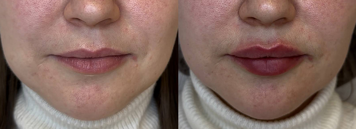 Контурная пластика губ 