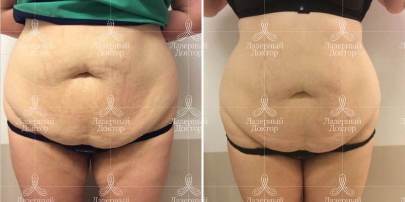 Подтяжка живота мезонитями