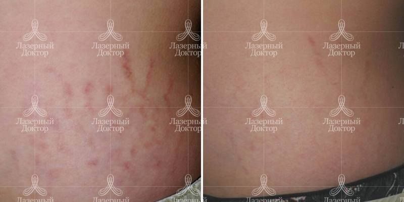 Убрать растяжки лазером (фото до и после)