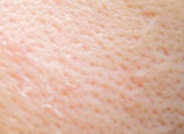 Карбоновый пилинг лица фото до и после