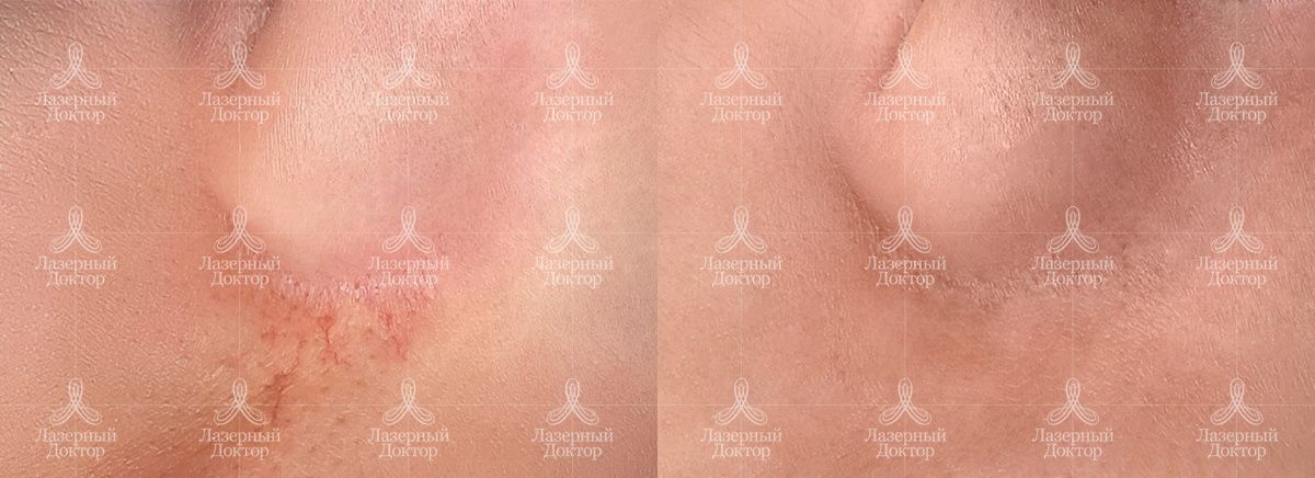 Удаление сосудов фото до и после