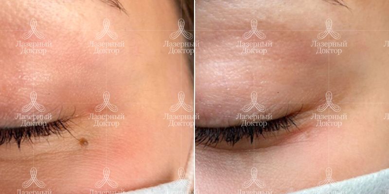 удаление новообразований